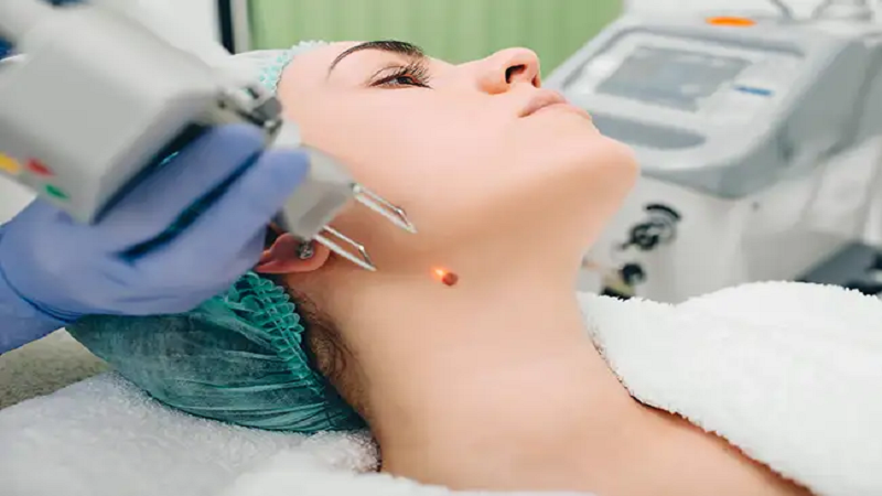 بهترین متخصص طب سنتی اصفهان | برداشتن خال و زگیل