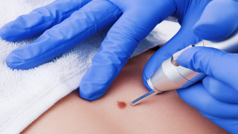  بهترین متخصص طب سنتی اصفهان | برداشتن خال و زگیل