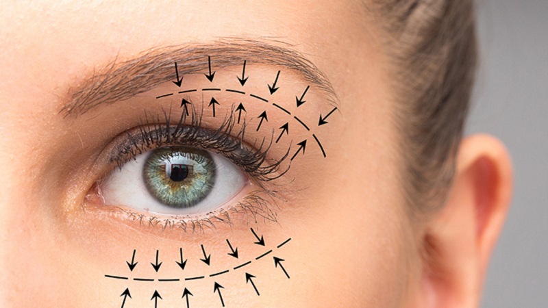 بهترین متخصص طب سنتی اصفهان |
بلفاروپلاستی برای درمان افتادگی پوستی