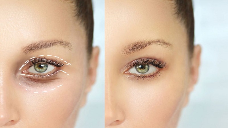 بهترین متخصص طب سنتی اصفهان | بلفاروپلاستی برای درمان افتادگی پوستی