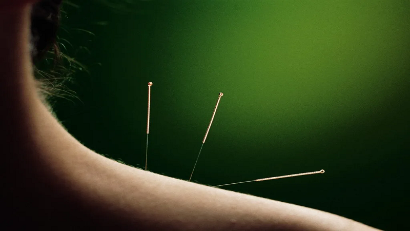 بهترین متخصص طب سنتی اصفهان | درمان دردهای حاد و مزمن با روش طب سوزنی چینی با انواع سوزن