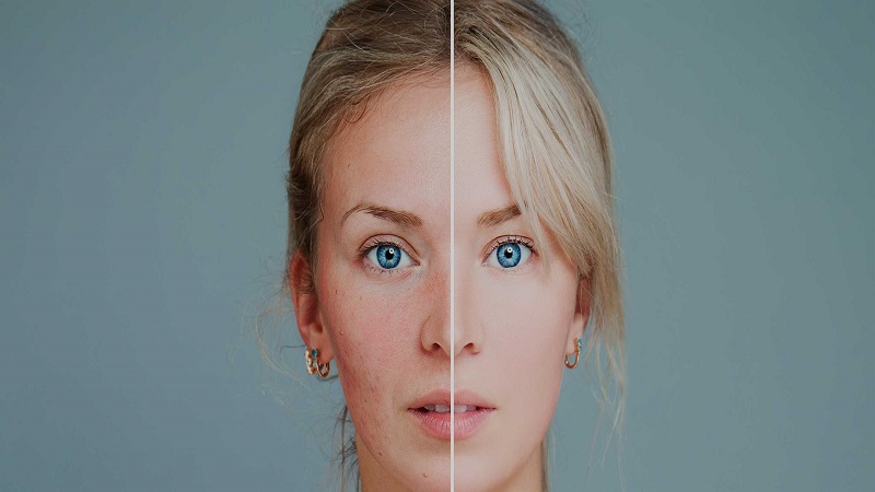 بهترین متخصص طب سنتی اصفهان | درمان لک صورت