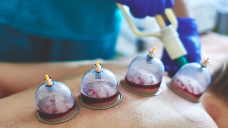 بهترین متخصص طب سنتی اصفهان | دکتر طب سنتی اصفهان | تفاوت حجامت با اهدای خون در چیست؟