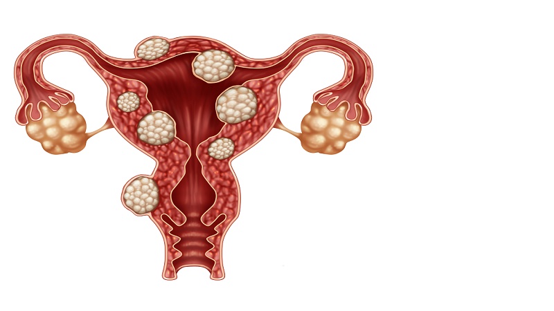 بهترین متخصص طب سنتی اصفهان | دکتر طب سنتی اصفهان | درمان قطعی فیبروم رحم با طب سنتی